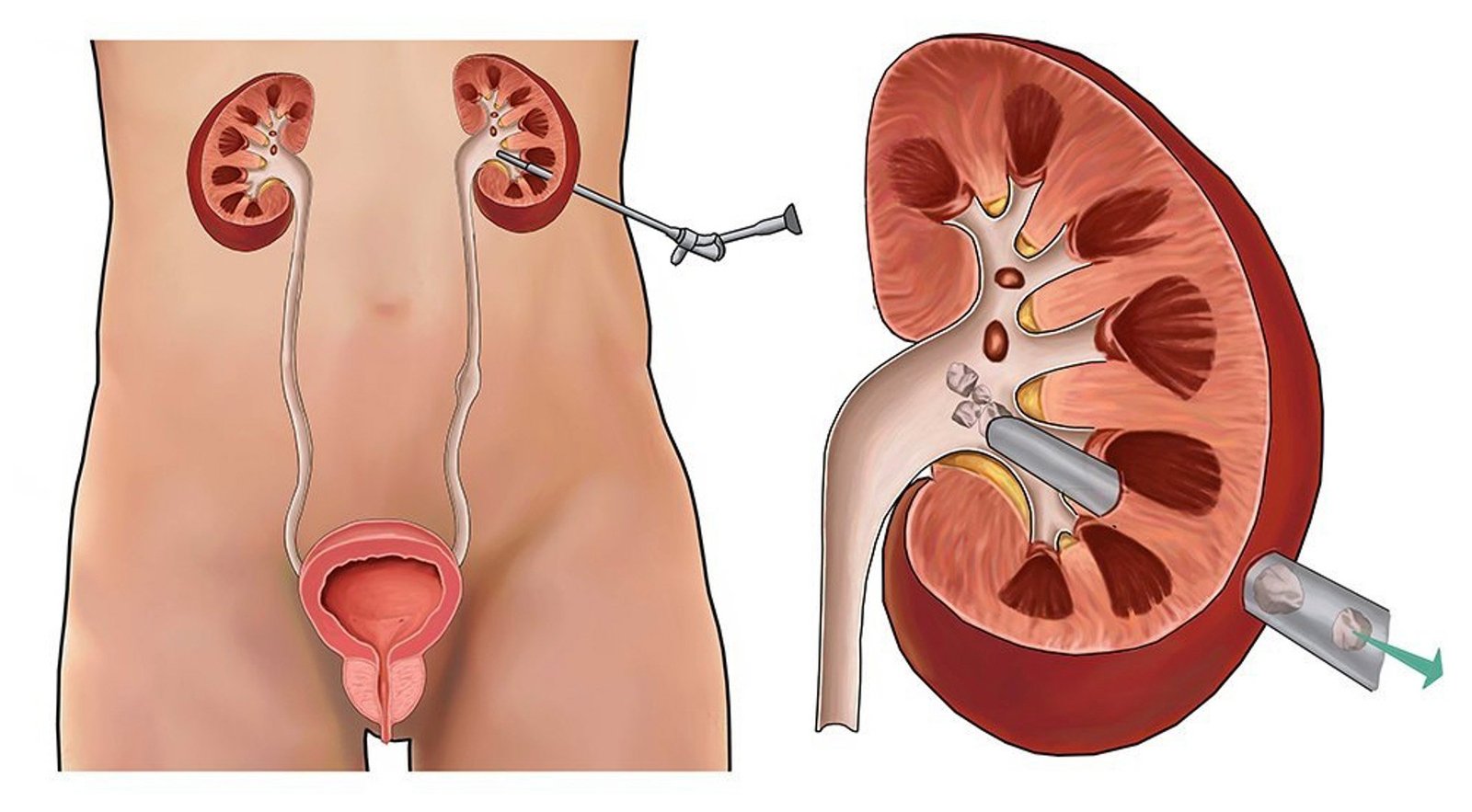 PCNLUrologicalSurgeonToowoombaDrNikhilSapre